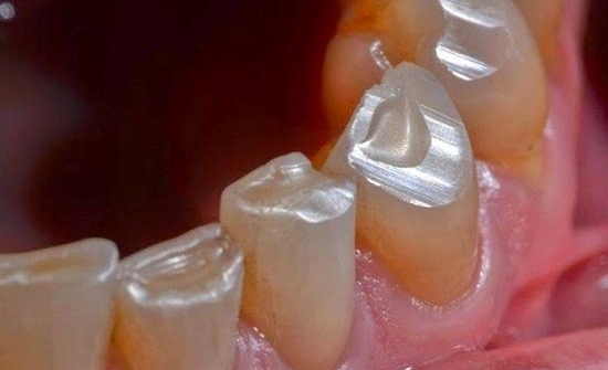 Priekinių dantų kandamųjų kraštų nudilimas